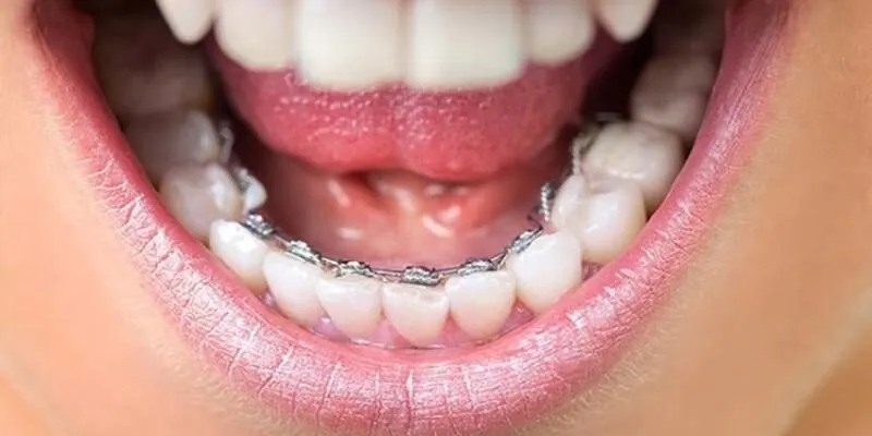 Niềng răng mặt trong