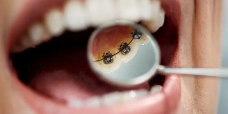 Niềng răng mặt trong