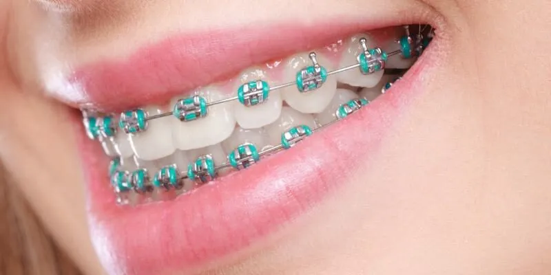 Niềng răng mắc cài kim loại