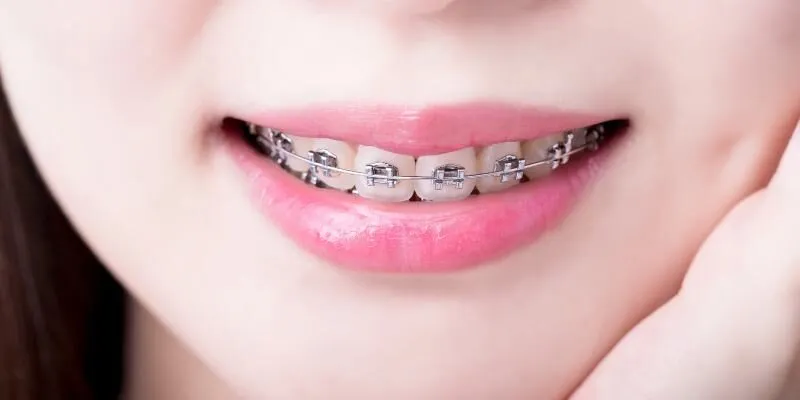 Niềng răng mắc cài kim loại