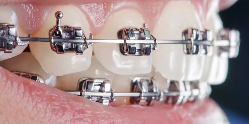 Niềng răng mắc cài kim loại